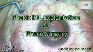 Phakic IOLICL Explantation amp Phaco surgery with IOL Implantation [upl. by Nakashima44]