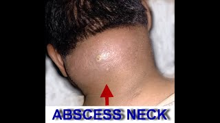 NECK ABSCESS 1 [upl. by Llenhoj]