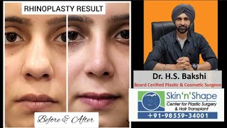 Transformed Confidence My Journey to a Beautiful New Nose  Bulbous Tip Success  Dr HS Bakshi [upl. by Issor]