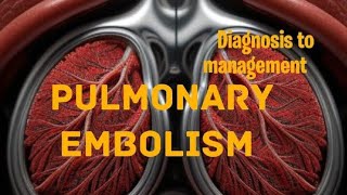 Pulmonary embolism  From Diagnosis to management [upl. by Lehsar]