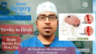 Stroke in Hindi  Stroke Kaise Pehchaane  Brain Stroke  Dr Sandeep Moolchandani  Neurosurgeon [upl. by Anelah]