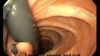 Right Colon Retroflexion [upl. by Bagger650]