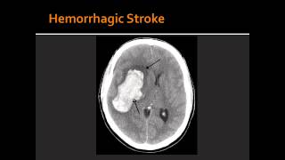 Atherosclerosis Hemorrhagic Stroke Ischemic Stroke amp Transient Ischemic Attack TIA [upl. by Walrath]