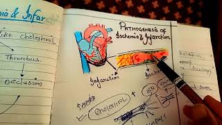 pathogenesis of ischemia and infarction NGMedicals [upl. by Nyer]