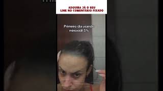 MINOXIDIL AJUDA DIMINUIR A TESTA [upl. by Aivato877]