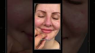 WARNING The “Pillow Face” Epidemic  Filler Face Syndrome  Part 1 facelift [upl. by Nylinej772]