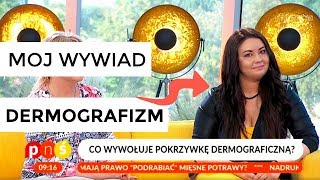 VLOG Pisanie po skórze w TV czyli Dermografizm [upl. by Asiralc]