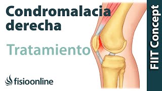 Tratamiento de la condromalacia rotuliana derecha [upl. by Rosalynd753]