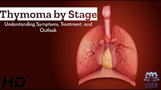 Decoding Thymoma A StagebyStage Guide to Symptoms amp Treatment [upl. by Kass524]