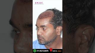 4000 Grafts Hair Transplant Results by Dr Suneet Soni at Medispa Hair Transplant Results [upl. by Aititel47]