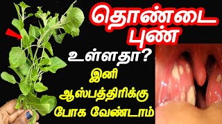 10இலையை கொதிக்க வைத்து 2முறை குடிங்க  thondai pun tamil maruthuvam  Throat Pain  thondai vali [upl. by Hercules211]