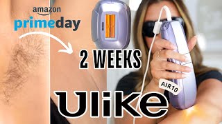 I Tried NEW Ulike Air10 IPL Hair Removal at Home BeforeAfter Results [upl. by Aneroc712]