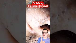 Crazy BLACKHEAD REMOVAL  Blackhead Extraction shorts [upl. by Damiano]