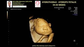 Hydrothorax  Hydrops fetalis 3435 weeks [upl. by Beora]