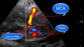 Transcranial Doppler Point of Care Ultrasound [upl. by Meade312]