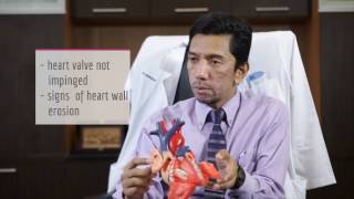 WHAT IS ATRIAL SEPTAL DEFECT ASD [upl. by Clair]