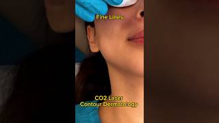 CO2 Laser Changed My Skin😱 acne acnescars beauty [upl. by Ruffi]