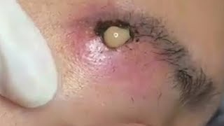 Big Cystic Acne Blackheads Extraction Blackheads amp Milia Whiteheads Removal Pimple Popping 099 [upl. by Racso]