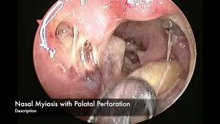 Nasal Myiasis with Palatal Perforation Maggots in Nose [upl. by Ethelred879]