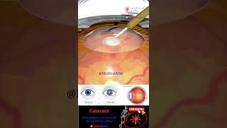 Cataract  Lens Implant  Medical Arts Shorts  3d animation surgery [upl. by Vitoria]