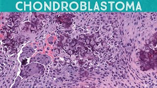 Chondroblastoma a bone tumor of children orthopedic surgery pediatric pathology usmle [upl. by Orin670]