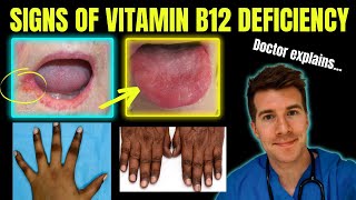 Doctor explains clinical signs of Vitamin B12 cobalamin deficiency  Glossitis mouth ulcers etc [upl. by Aramot]