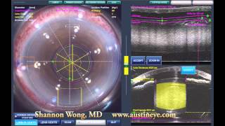 Lensx laser cataract surgery  brunescent cataract 101512 [upl. by Duggan]