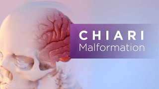 Chiari Malformation [upl. by Durarte]