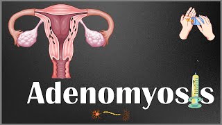 Adenomyosis  Definition Causes Risk Factors Signs amp Symptoms Diagnosis amp Treatment [upl. by Gutow]