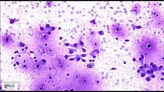 Cytology Thyroid nodule FNA  Metastatic breast carcinoma [upl. by Cardew156]