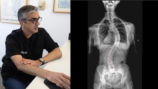 Severe Scoliosis Evaluation amp Treatment DrRahim Chiropractic [upl. by Deeyn]