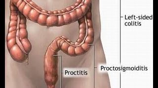 Treatment of Proctitis [upl. by Gabbi820]