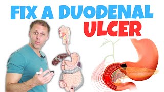 How to Correct a Duodenal Ulcer [upl. by Notyrb261]