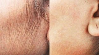 Remove Hair Permanently At Home Natural DIY  Face amp Upper Lip  SuperWowStyle [upl. by Erait583]