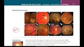 Retinal disorders  Neurology  33  First Aid USMLE in UrduHindi [upl. by Audi]