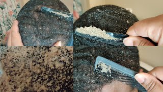 The Best Of the Itchy Scalp  Dandruff Compilation Pt 9 [upl. by Liban]