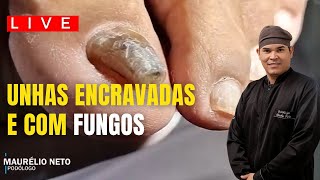 COMO RECUPERAR AS UNHAS ENCRAVADAS E COM FUNCOS podologomaurelio ingrowntoenail [upl. by Sergeant744]