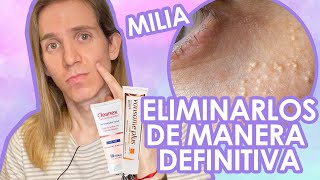 TRATAMIENTO de QUISTES DE MILLIUM o MILIA ¿Cómo eliminarlos Tratamiento Dermatologico [upl. by Nadual]