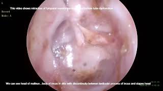 Grade IV Tympanic membrane retraction [upl. by Apollus855]