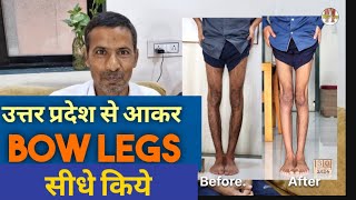 YOUNG BOY FIXED BOW LEGS IN VERY LESS TIME in 55 days complete recovery [upl. by Scarito]