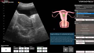 ASRM Embryo Transfer Simulator [upl. by Heimer]