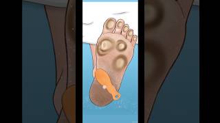 ASMR  foot warts remove treatment animation shorts asmr animation [upl. by Bard]