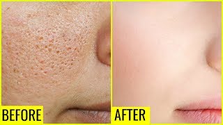 How to Get Rid of Large OPEN PORES Permanently  Anaysa [upl. by Herrle]