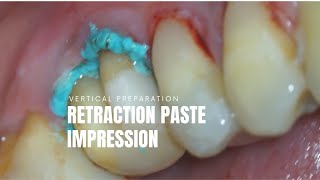 Retraction Paste amp Vertical Preparation amp Silicone Impression [upl. by Attenweiler]