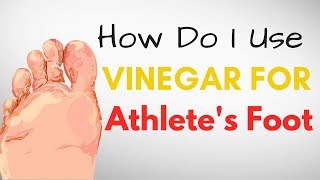 How Do I Use VINEGAR for Athletes Foot Treatment – 9 BEST Remedies [upl. by Mochun]