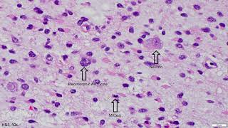 Diffuse Astrocytoma IDH mutant  Adventures in Neuropathology [upl. by Akirea]