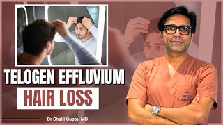 3 Common Causes of Telogen Effluvium Hair Loss You Need to Know  Dr Shaiil  Satya Hair Clinic [upl. by Kylila]