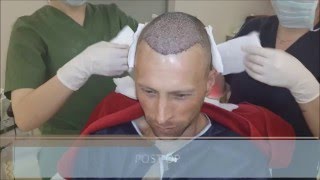 FUE Hair Transplant Growth Timeline  Health Travel International [upl. by Alyssa252]