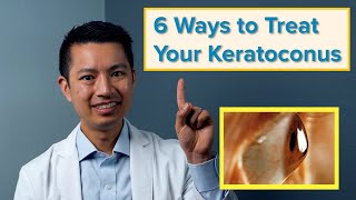 The 6 Best Ways to Treat Your Keratoconus [upl. by Nadler]