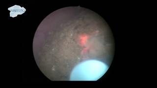 Laser Fragmentation of Large Bladder Stone [upl. by Vandyke]